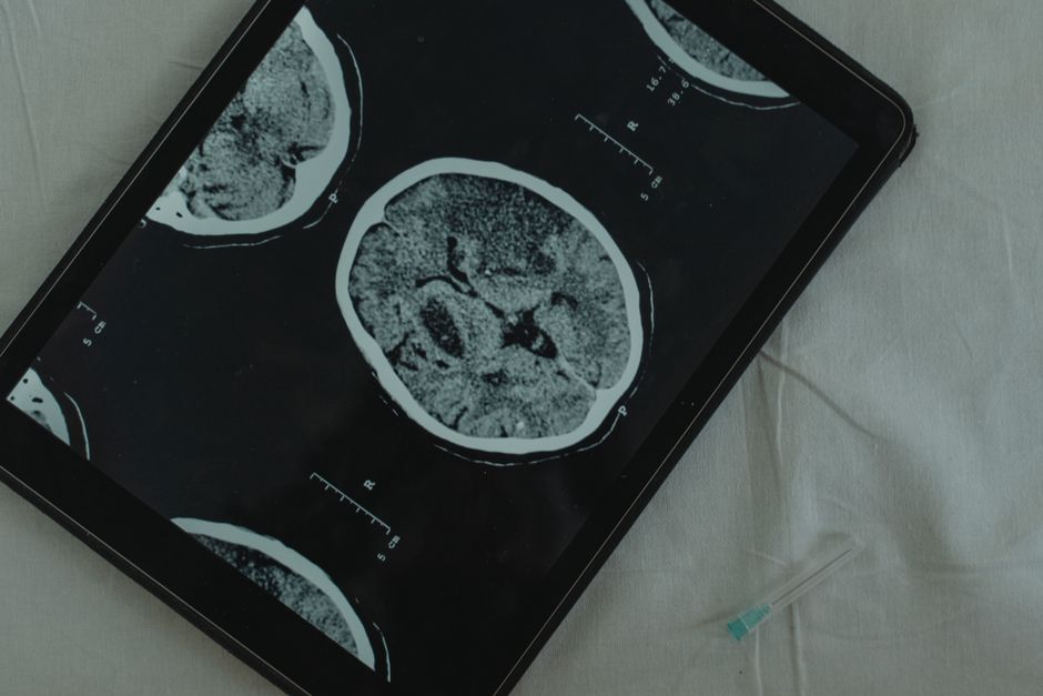New Research Highlights Neurological Challenges After Kidney Transplants