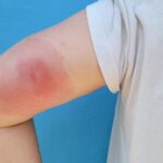 Understanding Skeeter Syndrome: When Mosquito Bites Cause Stronger Reactions