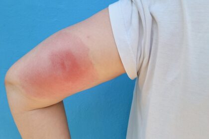 Understanding Skeeter Syndrome: When Mosquito Bites Cause Stronger Reactions