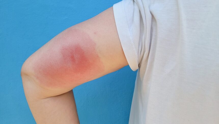 Understanding Skeeter Syndrome: When Mosquito Bites Cause Stronger Reactions
